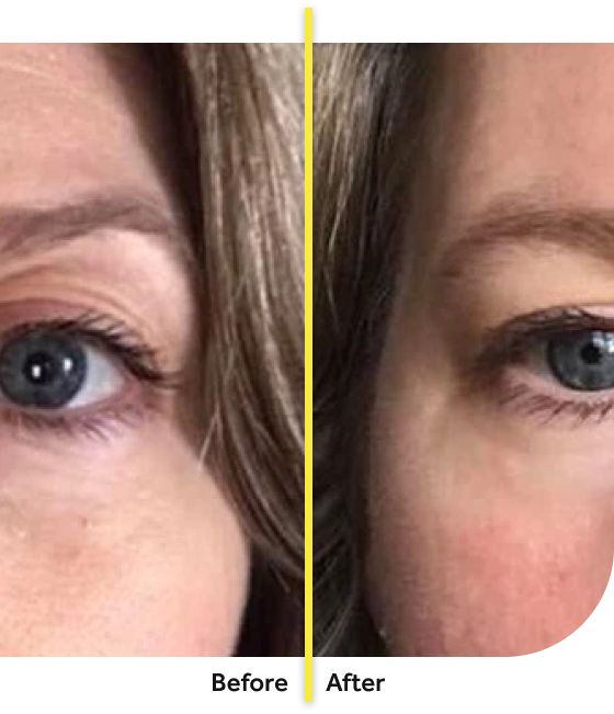 Avant et après Absolute Collagen